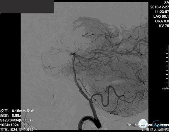 颈动脉瘤介入栓塞康复后可活多久,动脉瘤微创栓塞术全过程
