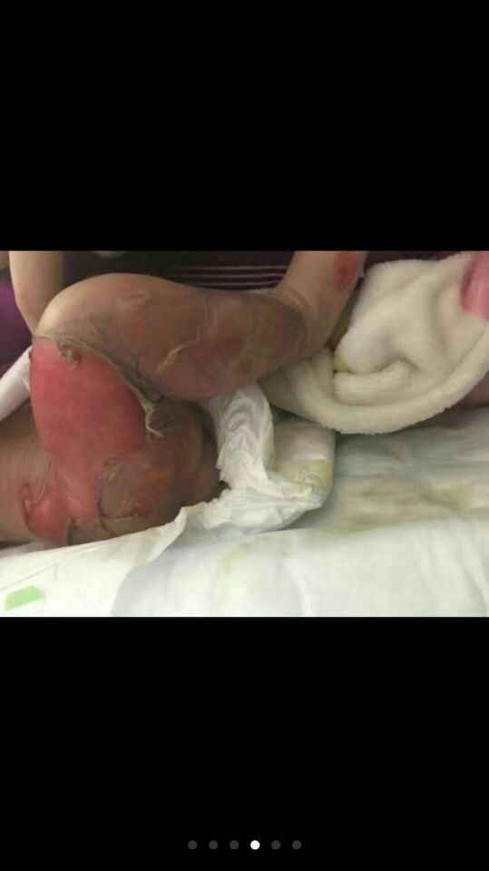 电暖袋爆炸事故视频,8个月孩子被电热毯烧伤后续