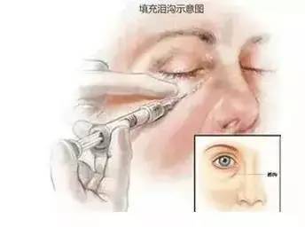 泪沟深怎么办,有了泪沟怎么补救