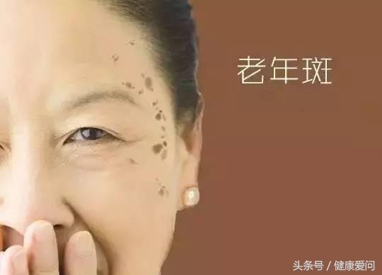 如何解决老年斑的最有效方法,解决老年斑的小妙招