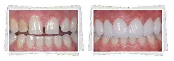 整牙=整容？看杨幂、刘涛、高圆圆为你亲身示范！