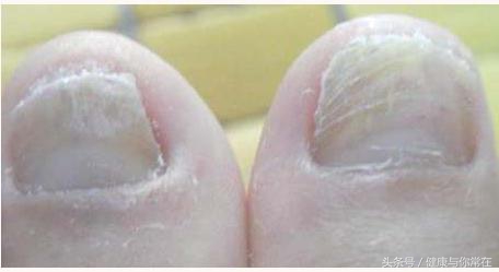 灰指甲怎么样才是灰指甲,灰指甲有几种形式的灰指甲