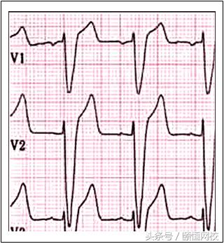 郭雅卿零基础心电图教学口诀,郭老师教你心电图口诀