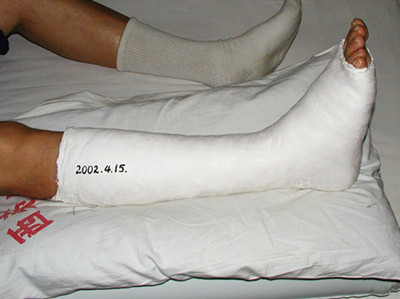 打了石膏最忌讳什么,拆完石膏应该注意什么