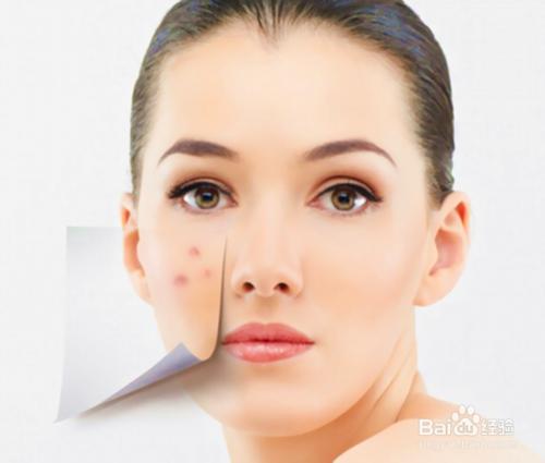 祛痘的小窍门教你如何快速消痘痘,长痘怎么办如何拯救痘痘肌肤