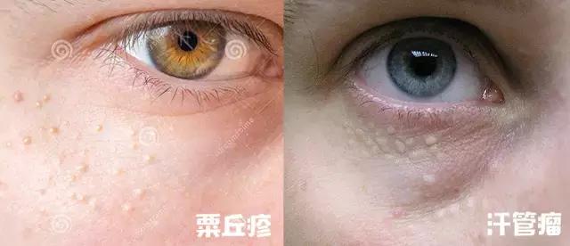 眼周有细纹用什么眼霜好用,护理眼周先用眼精华还是先用眼霜