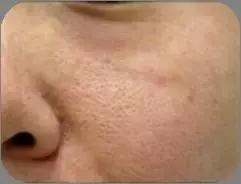 身体毛孔粗大并且里面是黑的,毛孔粗大变成了一个洞