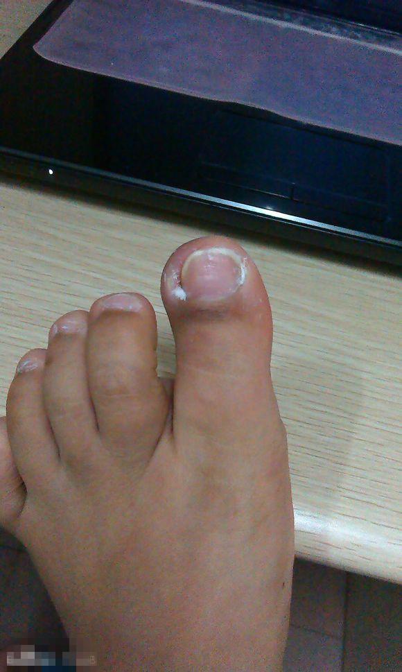 甲沟炎塞棉花法管用吗,甲沟炎塞棉花视频教程