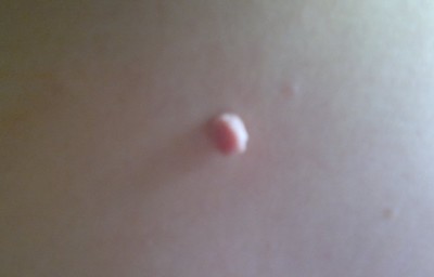 哪种植物叶子的汁治疗瘊子,有一种植物的种子治瘊子