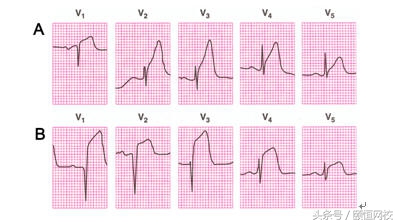 郭雅卿零基础心电图教学口诀,郭老师教你心电图口诀
