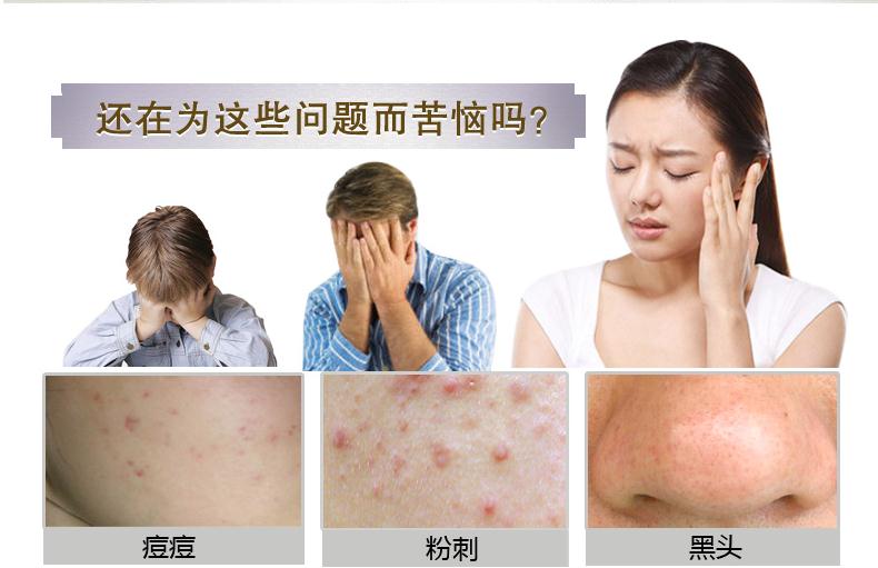 有什么方法祛痘有效最快,如何祛痘痘最有效的方法教给你