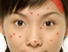 脸上长痘痘是什么原因一碰就疼,脸上长痘痘是什么原因怎么解决