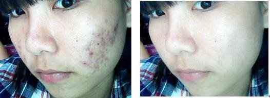 教你如何祛痘,有什么方法祛痘有效最快