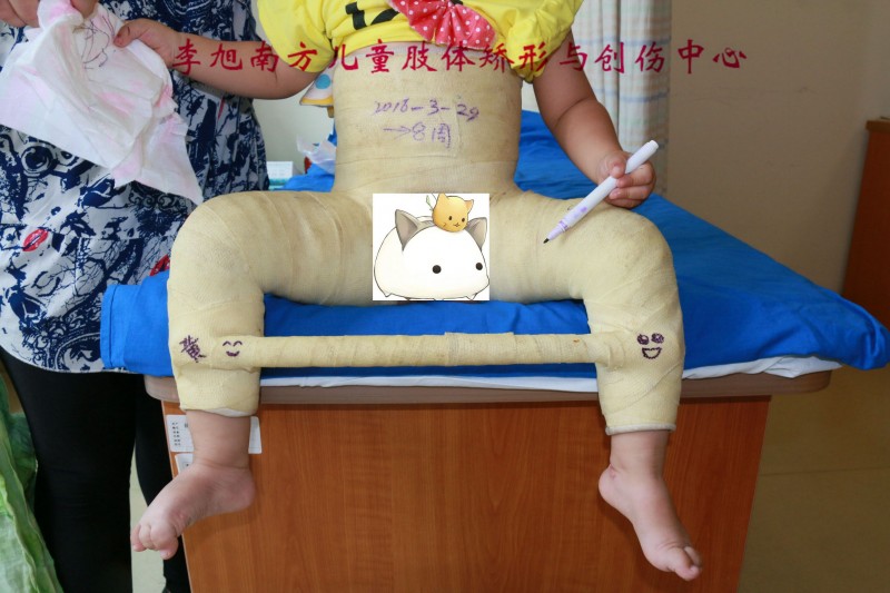 李旭儿童骨科髋关节,髋关节发育不良康复训练操