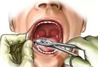 下颌阻生齿拔除技巧,下颌阻生智齿拔除会面瘫吗