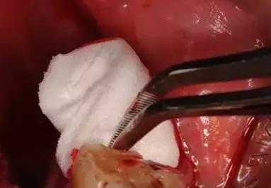 下颌阻生齿拔除技巧,下颌阻生智齿拔除会面瘫吗