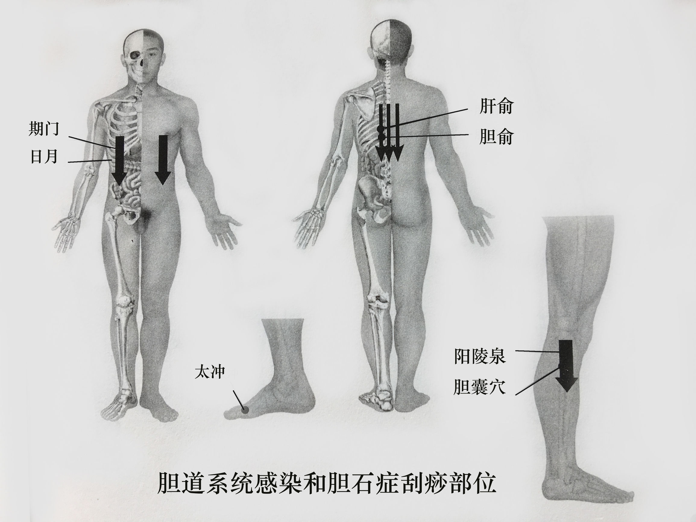 胆囊炎结石能不能刮痧拔罐,胆结石胆管炎胆囊炎中医能治愈吗
