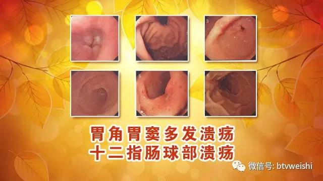 「养生堂」今日17:25播出：《消化重症的“逆转术”》