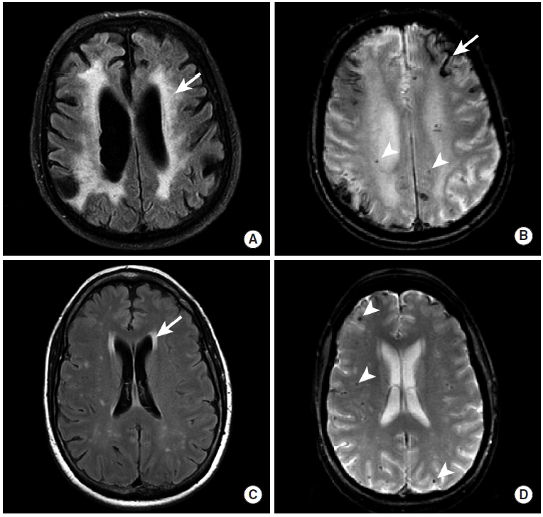 多图颅内出血影像学表现大全,头被撞后颅内出血有什么表现