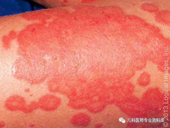 湿疹后有白斑是怎么回事,湿疹后白斑是白癜风