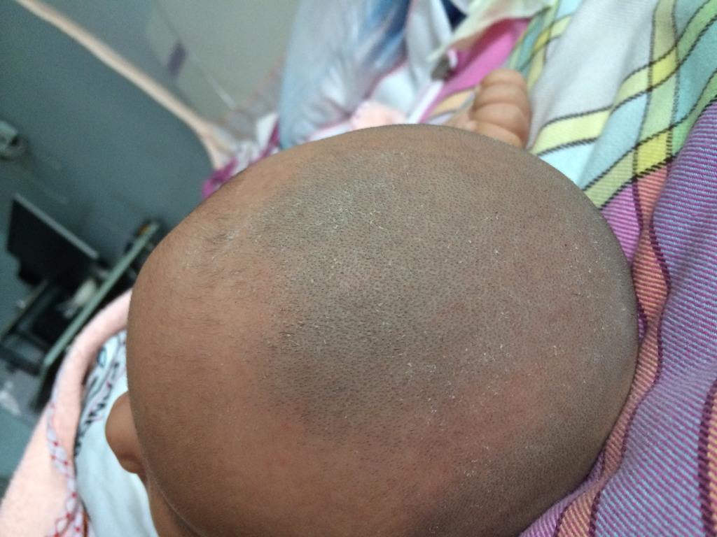 宝宝头上长很多污垢,宝宝头上污垢去除后又长多了