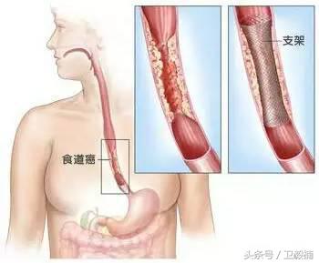 微创介入科一卫毅楠,什么是心血管介入治疗