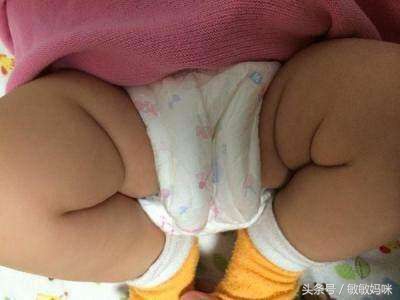 宝宝臀纹或大腿皮纹不对称怎么办,宝宝臀纹腿纹