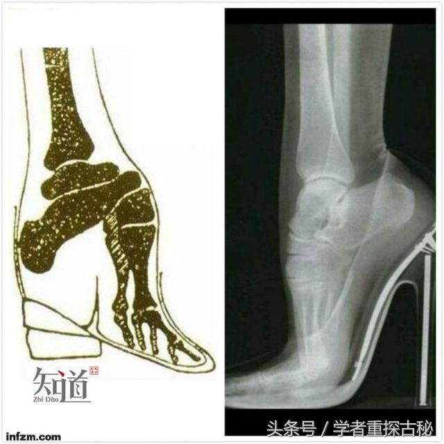 清末民初的陋习缠足,中国还有哪些像古代缠足这种陋习