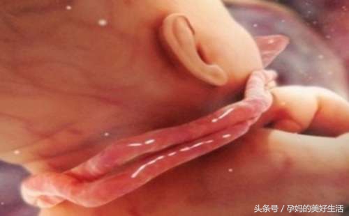 胎宝宝脐带绕颈是什么原因导致,37周胎儿脐带绕颈一周怎么纠正
