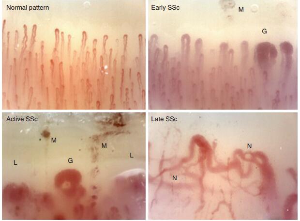系统性硬化症/硬皮病是什么样的疾病?