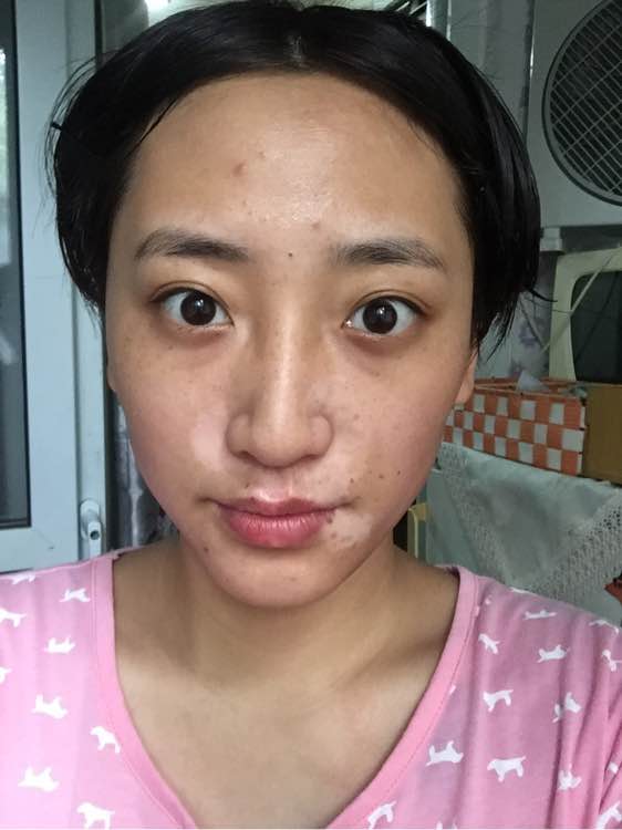 白斑光照,白斑光照后图片