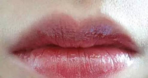 嘴唇上有几种颜色是什么病,嘴唇肿要警惕四种慢性病