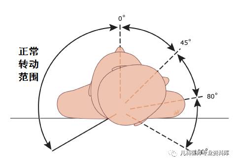 痉挛性斜颈患者说出了大秘密,痉挛性斜颈脖子歪照片