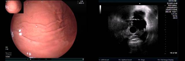 当EUS遇到“假瘤子”(二)——都是“隔壁老王”惹的祸(毗邻外压)