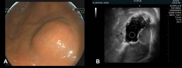当EUS遇到“假瘤子”(二)——都是“隔壁老王”惹的祸(毗邻外压)