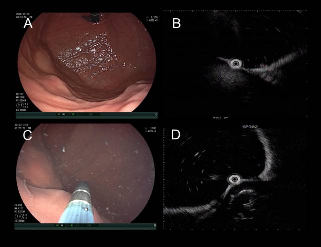 当EUS遇到“假瘤子”(二)——都是“隔壁老王”惹的祸(毗邻外压)