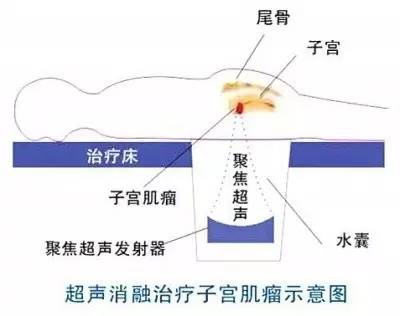 海扶刀治愈癌症吗,海扶刀治疗癌症的无创利器