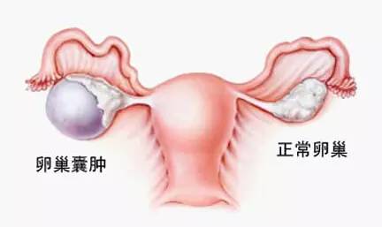 「惊呆」柳州一大妈肚子大得像怀孕7个月，医生打开后惊呆了……