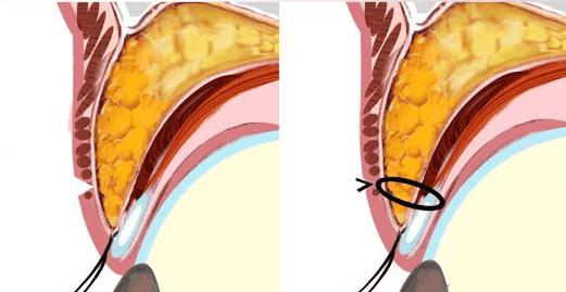 纳米无痕双眼皮埋线怎么恢复得快,埋线双眼皮拆线能恢复到原来吗