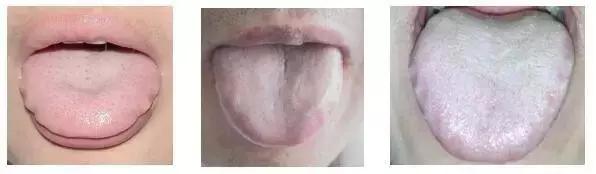 舌苔辨证图谱望舌识病,揭秘舌苔图谱轻松自诊