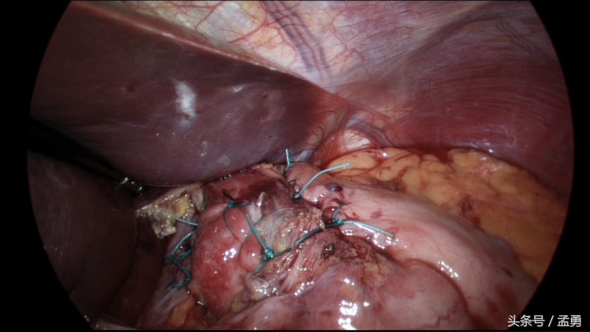 轻微的胆管系统损伤,胆管阻塞治疗方法