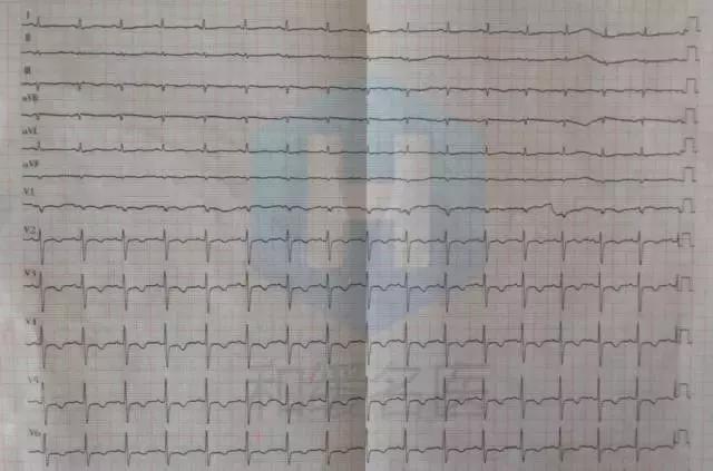 心脏支架后还有胸痛的症状怎么办,心脏支架后还是心绞痛是什么原因