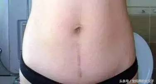 剖宫产疤痕恢复效果的好与坏，有哪些影响因素？