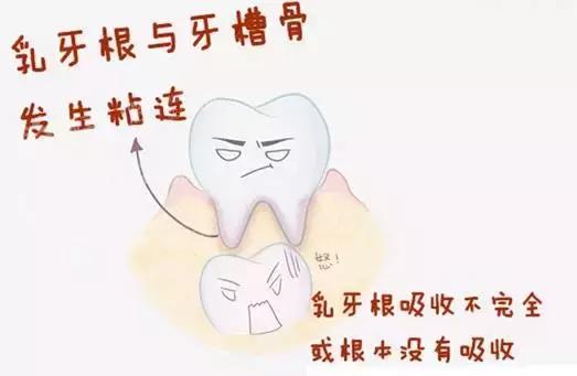 乳牙滞留的图片,下切牙乳牙滞留