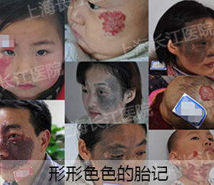 胎记不及时治疗会恶变吗,胎记不治疗对生命有影响吗