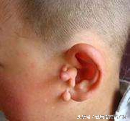 新生儿耳朵长个小附耳怎么造成的,5岁男童耳朵长副耳要住院吗
