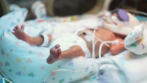 早产儿刚出生24小时照顾详细流程,早产儿救治