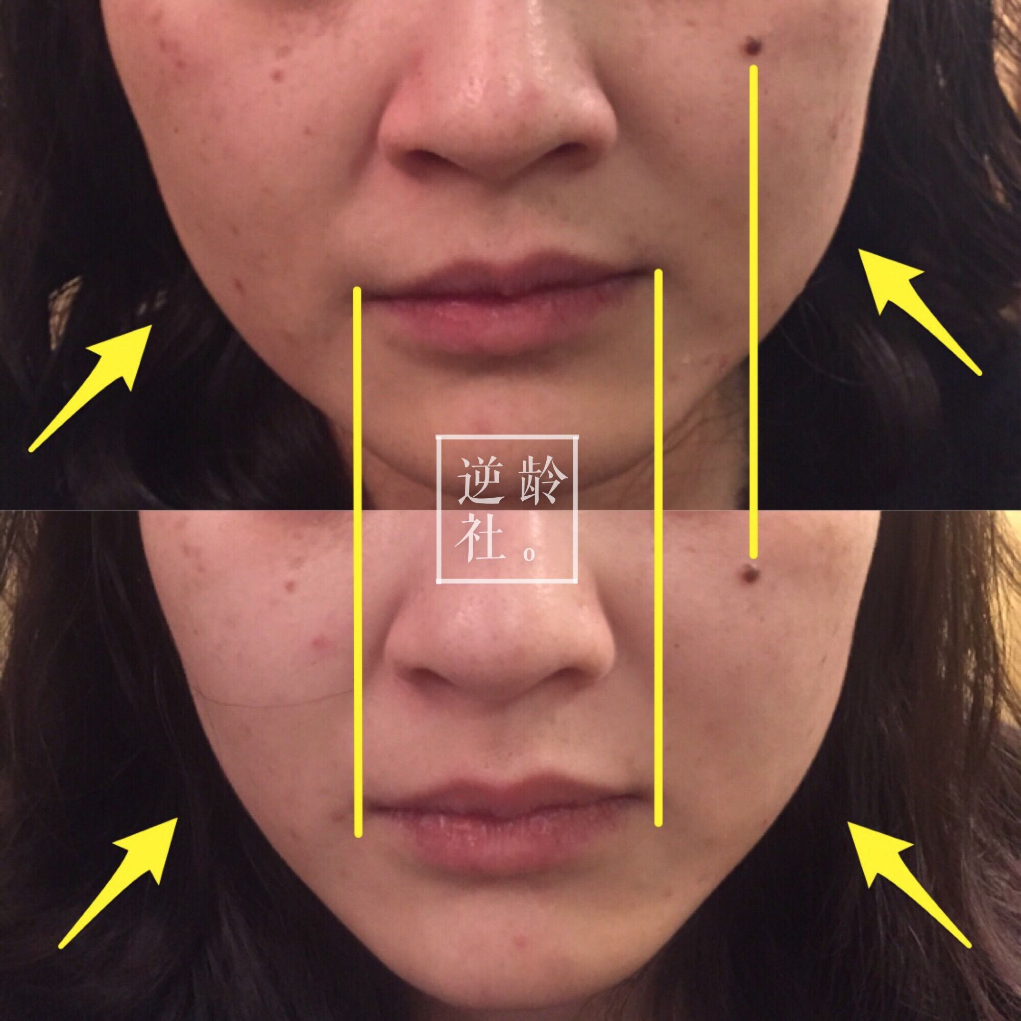 逆龄精雕好还是超声刀好,35岁做超声刀效果好吗