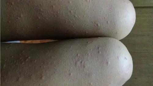 慢性荨麻疹的自愈方法,荨麻疹自愈的最佳治疗方法