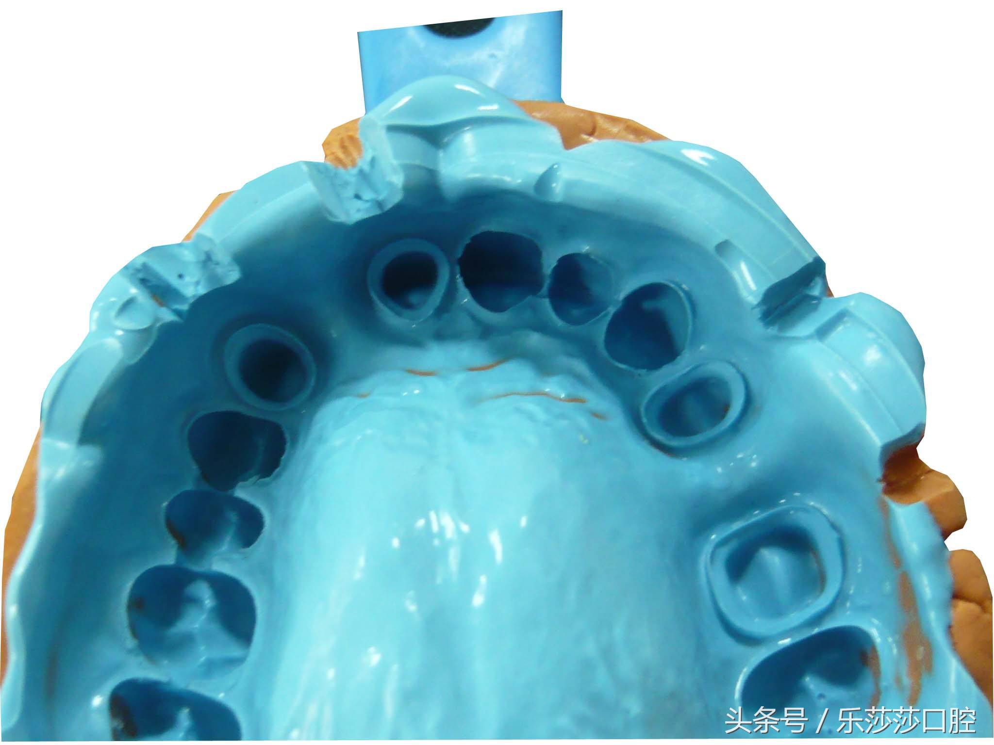 为什么牙医爱忽悠人做烤瓷牙,牙医的真相大全